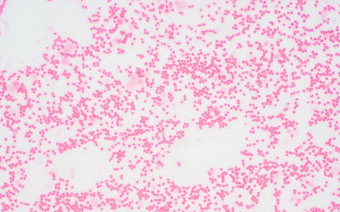 Síndromes mielodisplásicos: “una médula que trabaja poco y mal”