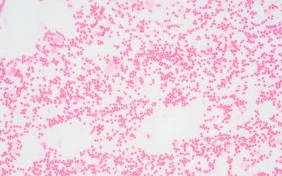 Síndromes mielodisplásicos: “una médula que trabaja poco y mal”